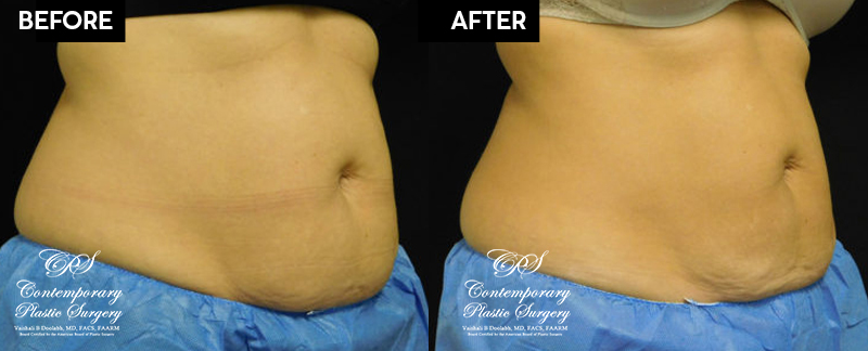 Patient's before and after results from CoolSculpting treatment at Contemporary Plastic Surgery