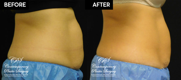 Patient's before and after results from CoolSculpting treatment at Contemporary Plastic Surgery