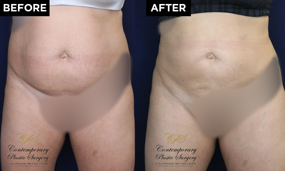Liposuction and Renuvion patient before and after results at Contemporary Plastic Surgery