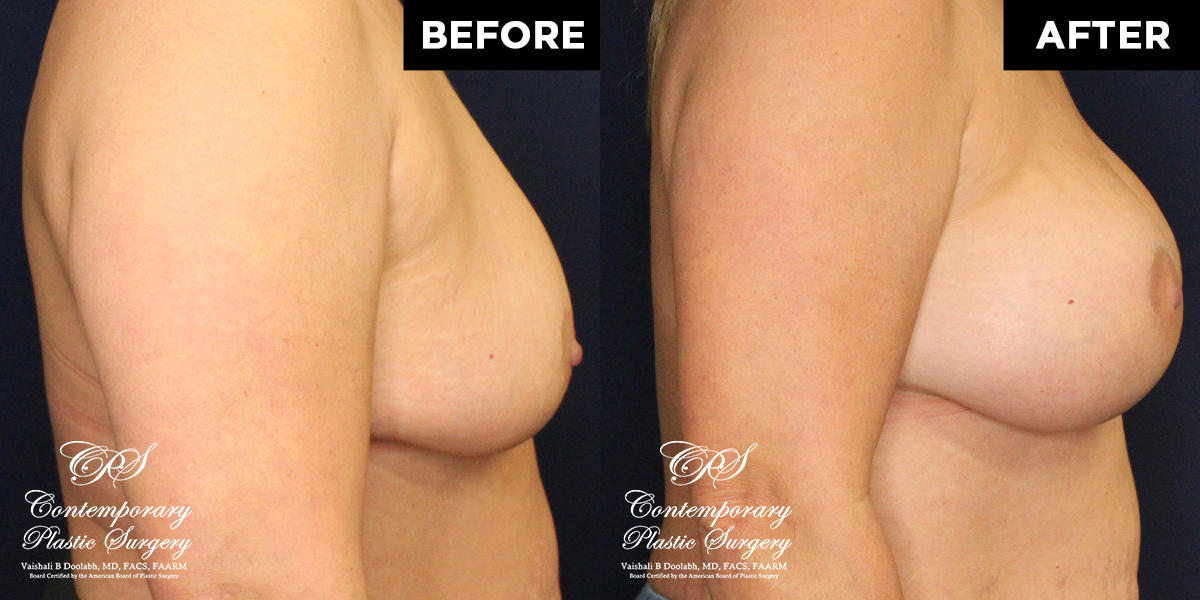 breast lift before and after