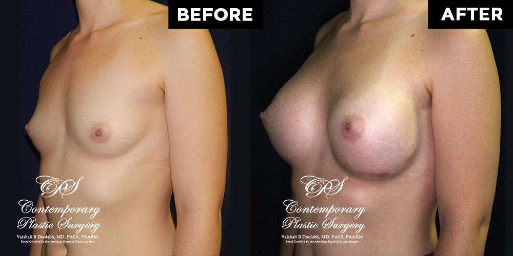 Patient #11430’s Breast Augmentation at Jacksonville plastic surgery clinic, Contemporary Plastic Surgery
