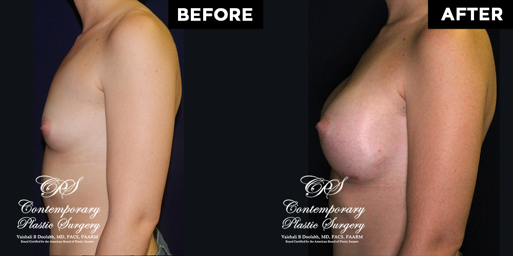 Patient #11430’s Breast Augmentation at Jacksonville plastic surgery clinic, Contemporary Plastic Surgery