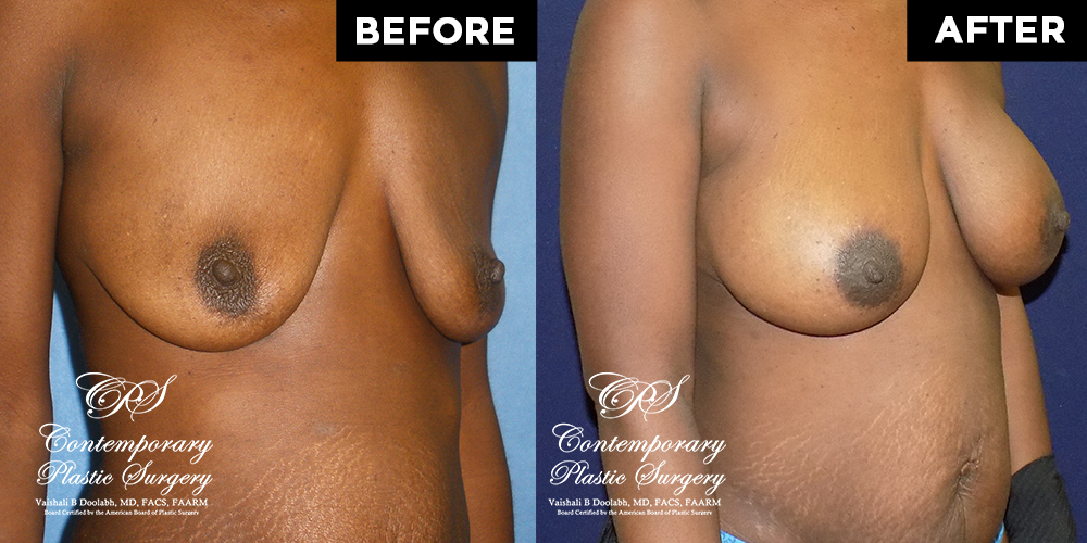 Patient #4161’s Breast Augmentation at Jacksonville plastic surgery clinic, Contemporary Plastic Surgery