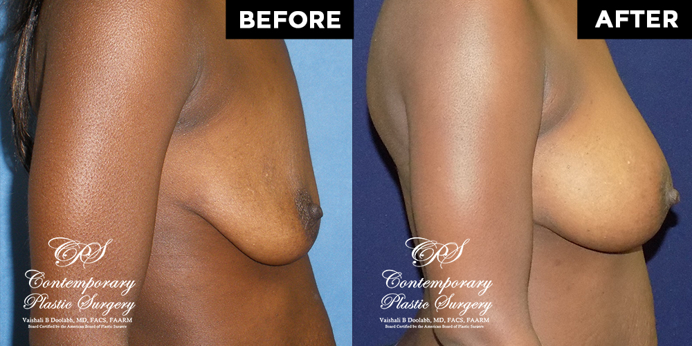 Patient #4161’s Breast Augmentation at Jacksonville plastic surgery clinic, Contemporary Plastic Surgery
