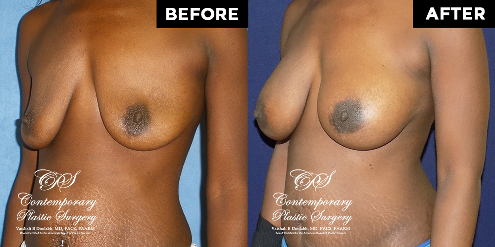 Patient #4161’s Breast Augmentation at Jacksonville plastic surgery clinic, Contemporary Plastic Surgery