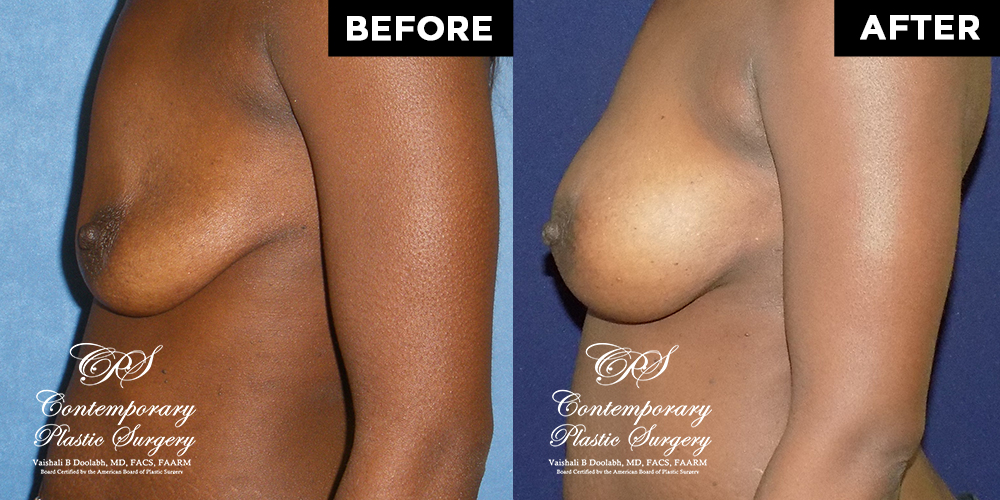 Patient #4161’s Breast Augmentation at Jacksonville plastic surgery clinic, Contemporary Plastic Surgery