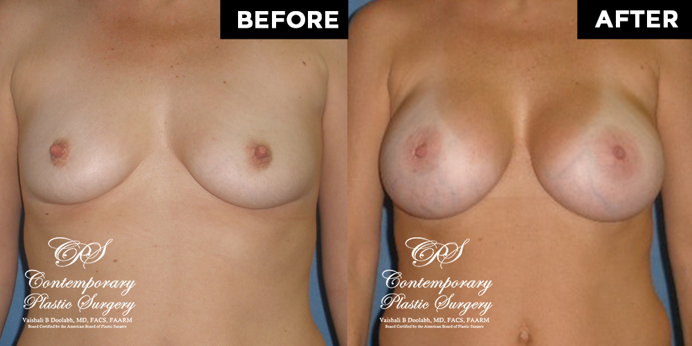 Patient #11374’s Breast Augmentation at Jacksonville plastic surgery clinic, Contemporary Plastic Surgery
