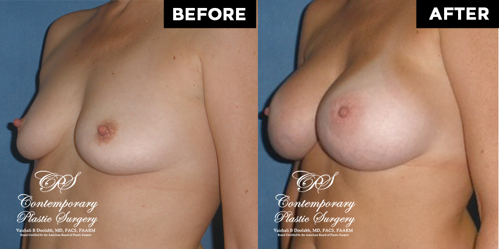 Patient #11374’s Breast Augmentation at Jacksonville plastic surgery clinic, Contemporary Plastic Surgery