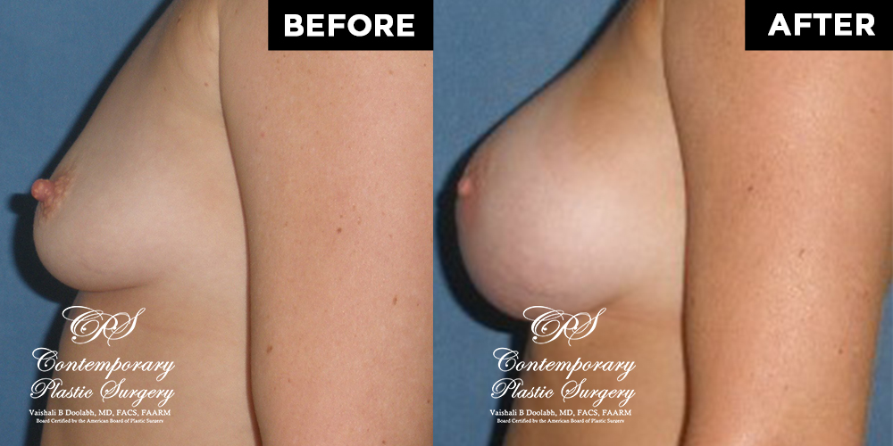 Patient #11374’s Breast Augmentation at Jacksonville plastic surgery clinic, Contemporary Plastic Surgery