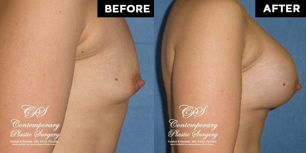 Patient #12694’s Breast Augmentation at Jacksonville plastic surgery clinic, Contemporary Plastic Surgery