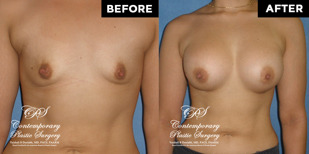 Patient #12694’s Breast Augmentation at Jacksonville plastic surgery clinic, Contemporary Plastic Surgery