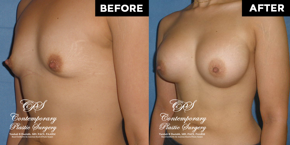Patient #12694’s Breast Augmentation at Jacksonville plastic surgery clinic, Contemporary Plastic Surgery