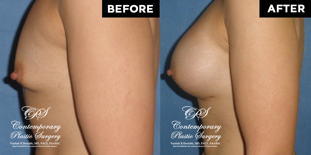 Patient #12694’s Breast Augmentation at Jacksonville plastic surgery clinic, Contemporary Plastic Surgery
