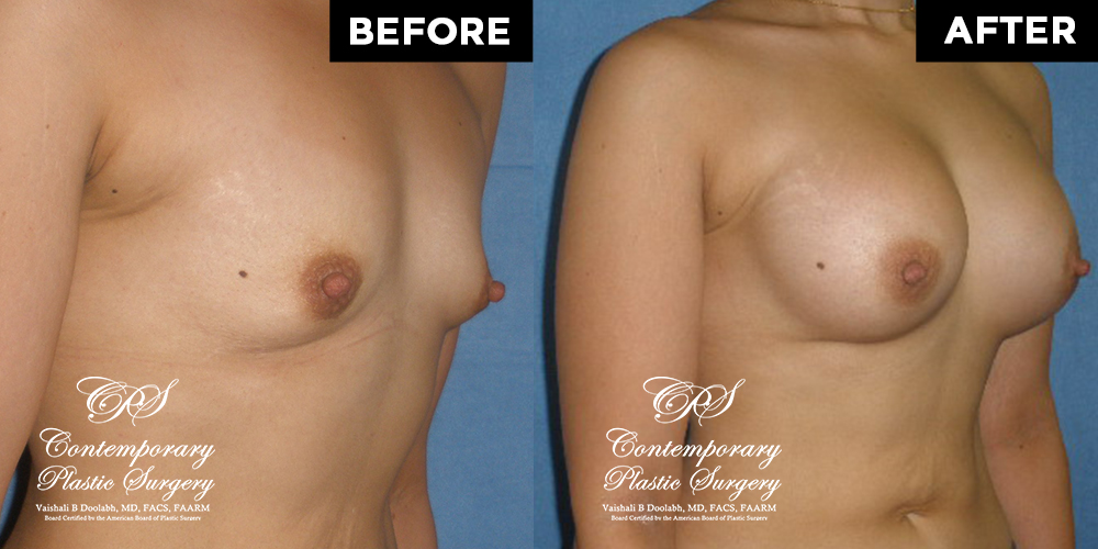 Patient #12694’s Breast Augmentation at Jacksonville plastic surgery clinic, Contemporary Plastic Surgery
