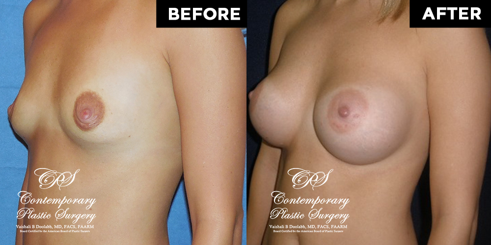 Patient #13034’s Breast Augmentation at Jacksonville plastic surgery clinic, Contemporary Plastic Surgery