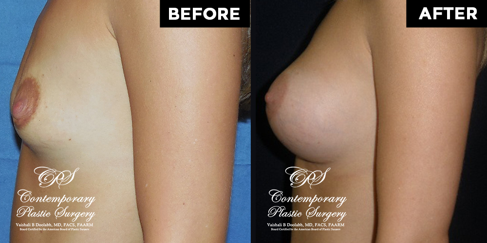 Patient #13034’s Breast Augmentation at Jacksonville plastic surgery clinic, Contemporary Plastic Surgery