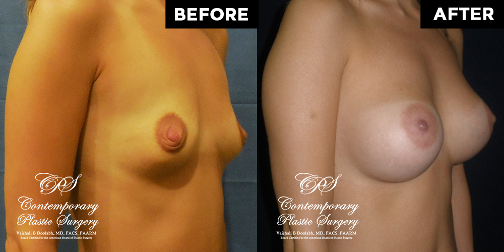 Patient #13034’s Breast Augmentation at Jacksonville plastic surgery clinic, Contemporary Plastic Surgery