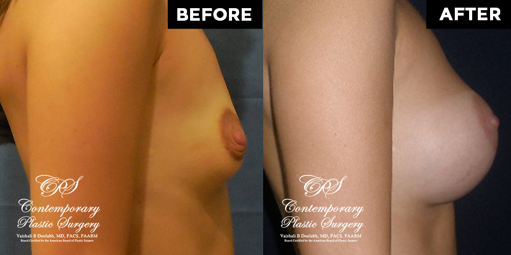 Patient #13034’s Breast Augmentation at Jacksonville plastic surgery clinic, Contemporary Plastic Surgery