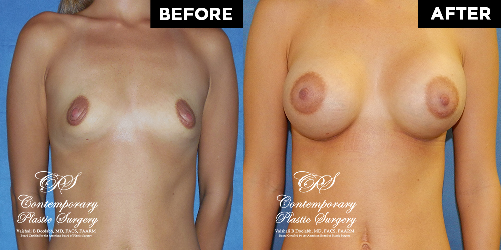 Patient #13034’s Breast Augmentation at Jacksonville plastic surgery clinic, Contemporary Plastic Surgery