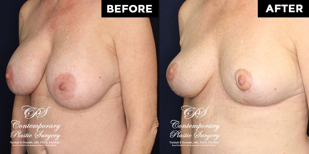 breast lift before and after