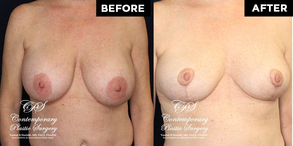 breast lift before and after