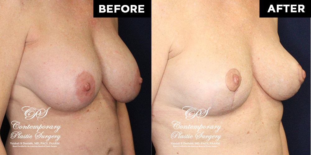 breast lift before and after