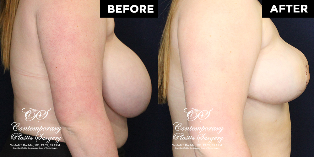 breast lift before and after