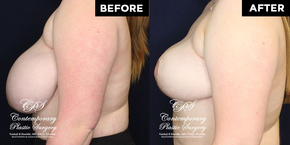 breast lift before and after