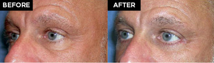 lower eyelid lift patient results at Contemporary Plastic Surgery