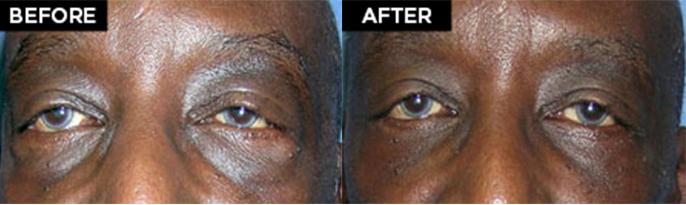 lower eyelid lift patient results at Contemporary Plastic Surgery