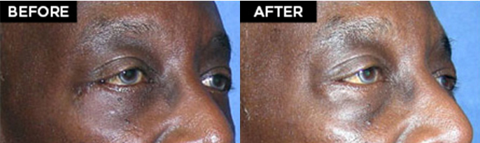 lower eyelid lift patient results at Contemporary Plastic Surgery