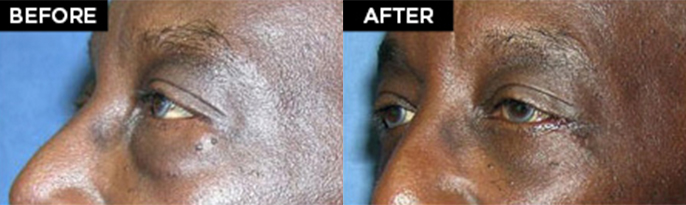 lower eyelid lift patient results at Contemporary Plastic Surgery