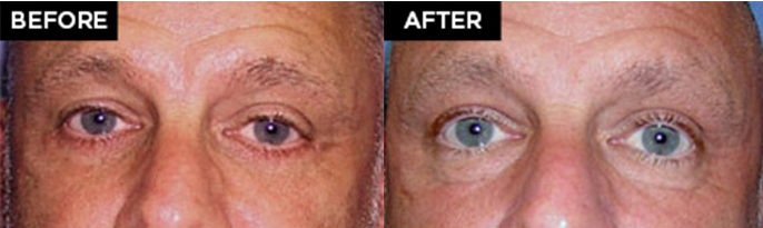 lower eyelid lift patient results at Contemporary Plastic Surgery
