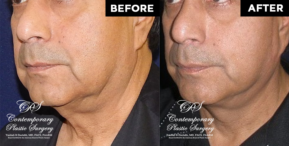 male face lift results at Contemporary Plastic Surgery