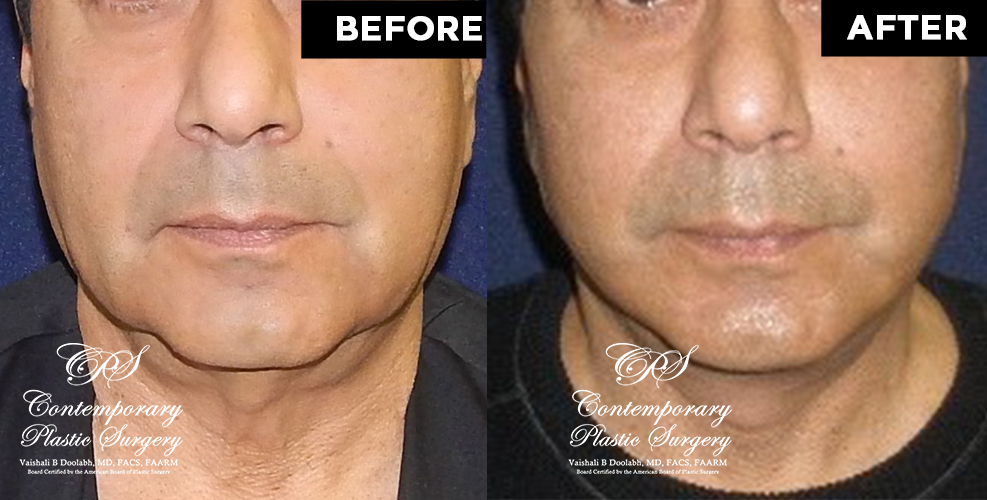 male face lift results at Contemporary Plastic Surgery