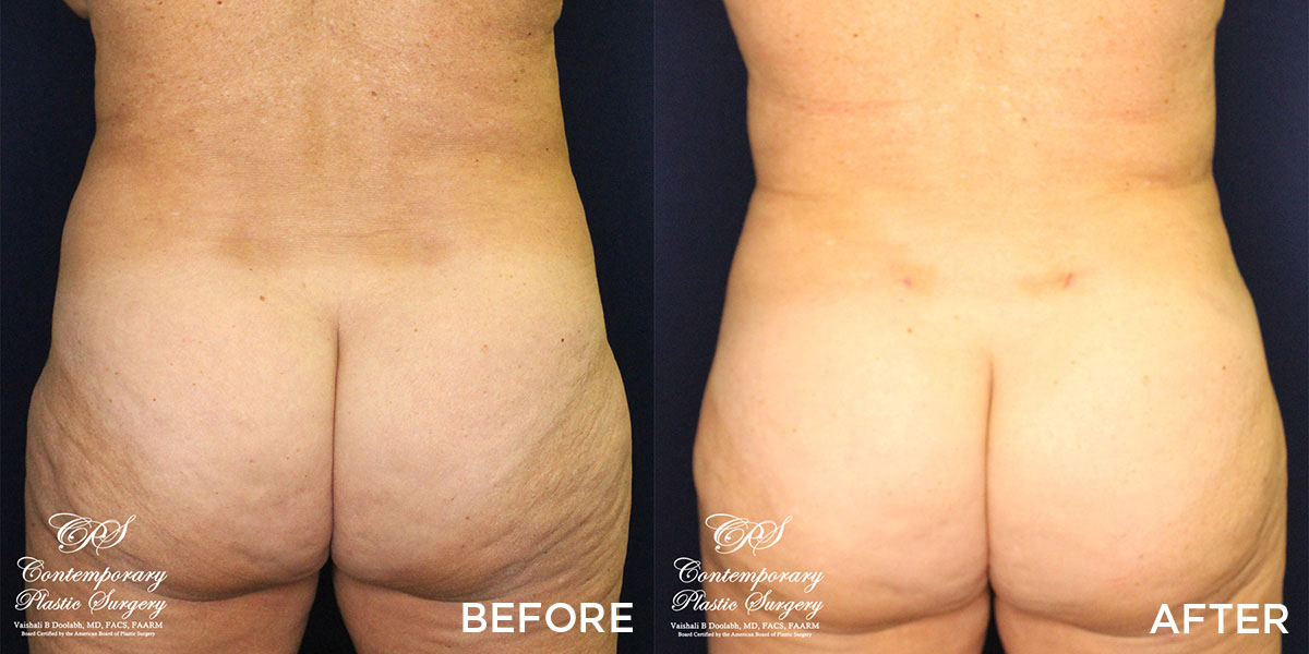 liposuction and Renuvion® before and after results at Contemporary Plastic Surgery
