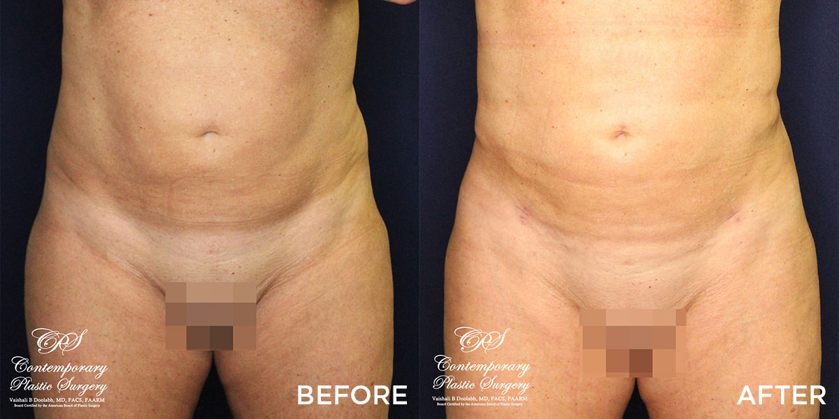 liposuction and Renuvion® contouring before and after results at Contemporary Plastic Surgery