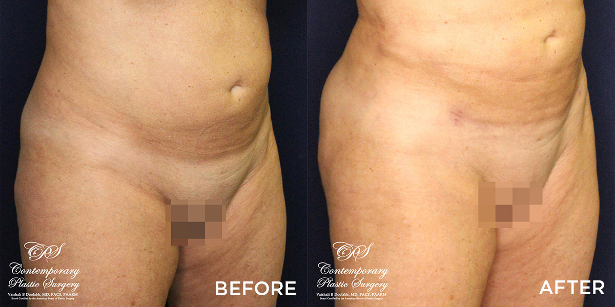 liposuction and Renuvion® before and after results at Contemporary Plastic Surgery