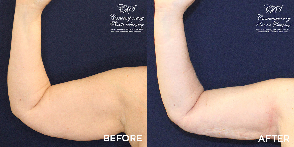 liposuction and Renuvion® contouring before and after results at Contemporary Plastic Surgery