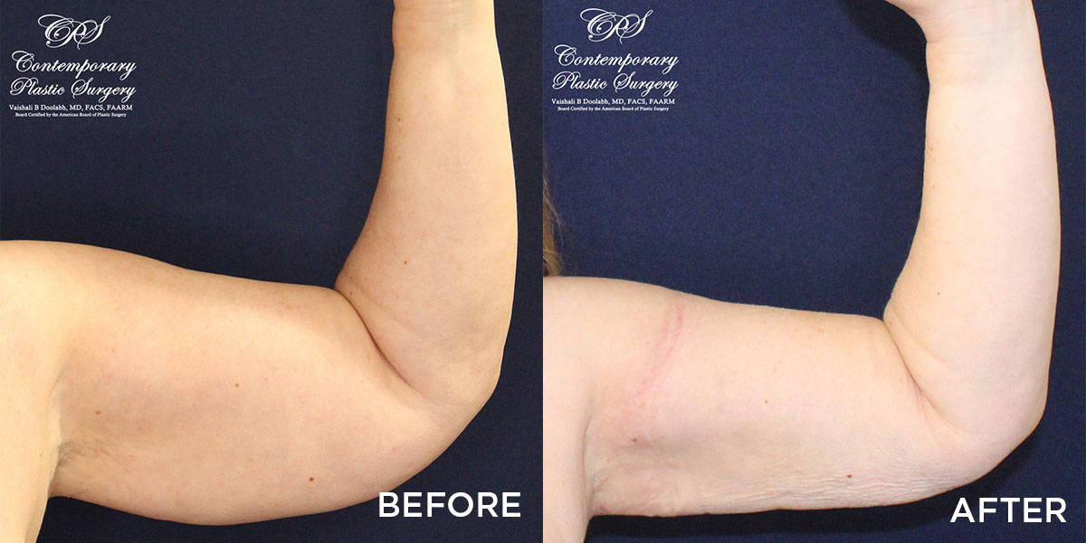 liposuction and Renuvion® contouring before and after results at Contemporary Plastic Surgery