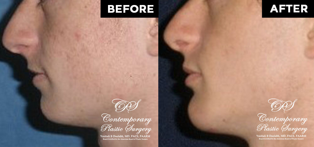 patient chin augmentation surgery results at Contemporary Plastic Surgery