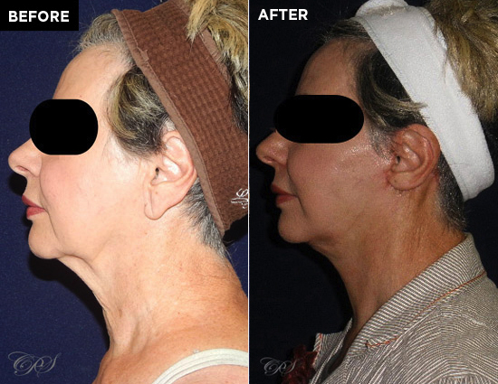 neck lift