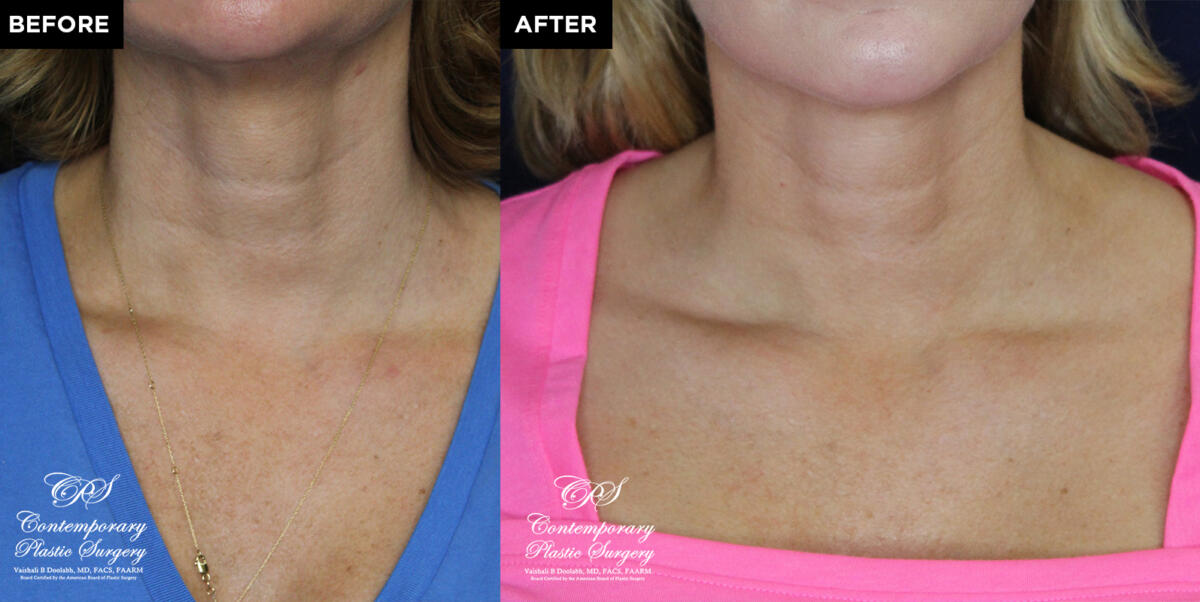 Radiesse injection before and after results at Contemporar Plastic Surgery