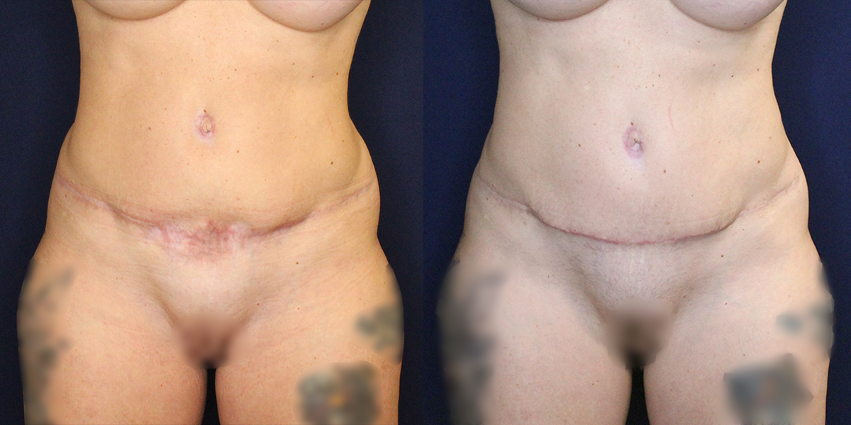Patient 16836's results from a scar revision with fat transfer procedure at Contemporary Plastic Surgery