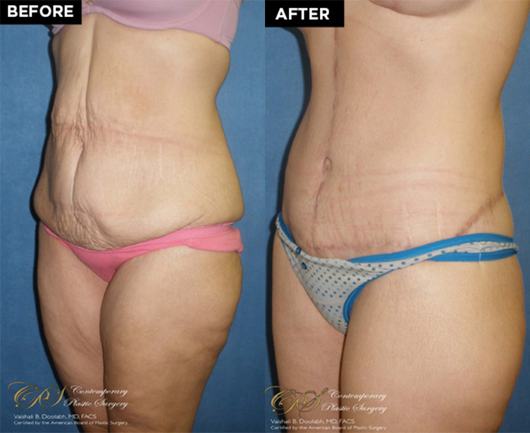 lower body lift patient before and after results at Contemporary Plastic Surgery