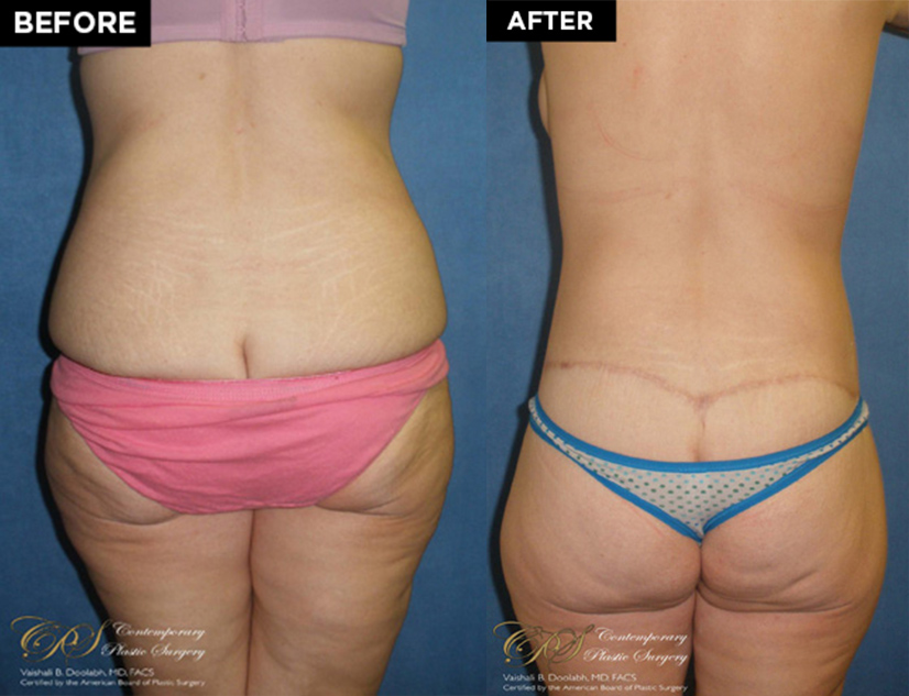 lower body lift patient before and after results at Contemporary Plastic Surgery