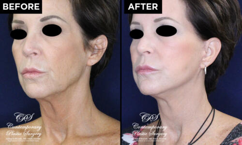 face lift and eyelid lift patient results at Contemporary Plastic Surgery