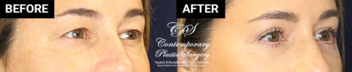 Eyelid surgery patient results at Contemporary Plastic Surgery