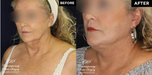 lower face and neck lift