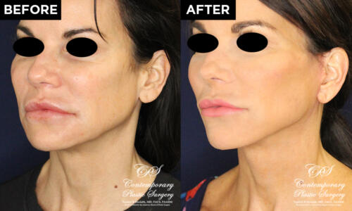 face and neck lift patient results at Contemporary Plastic Surgery